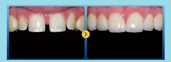 HOT: Bọc răng sứ không mài răng với giá chỉ 1.000đ! - 10