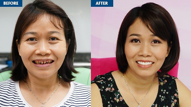 Hậu quả mất răng vĩnh viễn của việc mài răng bọc sứ sai cách - 3