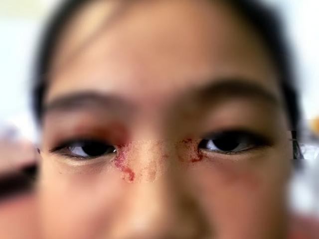 Phi thường - kỳ quặc - Bé gái 11 tuổi toát mồ hôi như máu ở Việt Nam