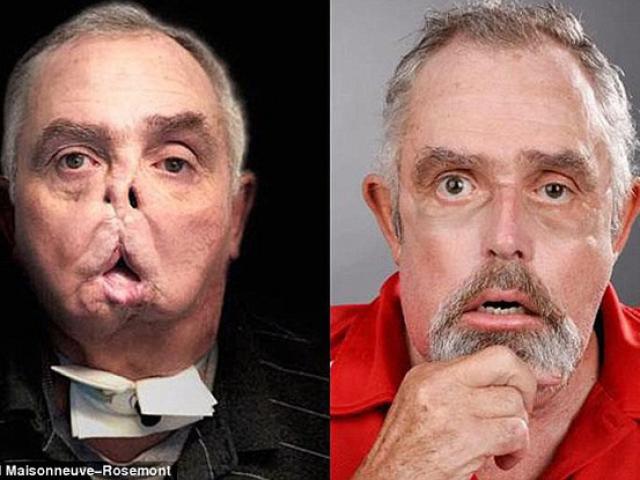 Sức khỏe đời sống - Cận cảnh ca ghép mặt cực kỳ hoàn hảo cho người thợ săn