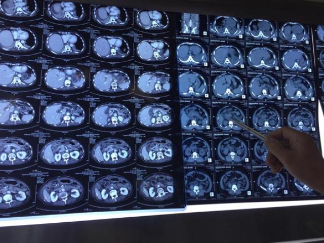 Sức khỏe đời sống - “Viêm tụy cấp” - đích đến của những người “dành cả tuổi thanh xuân” chỉ để uống rượu