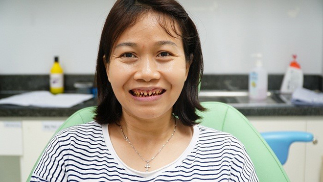 Hiểm hoạ từ mài răng để bọc răng sứ do thiếu hiểu biết - 2