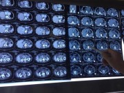 Sức khỏe đời sống - “Viêm tụy cấp” - đích đến của những người “dành cả tuổi thanh xuân” chỉ để uống rượu