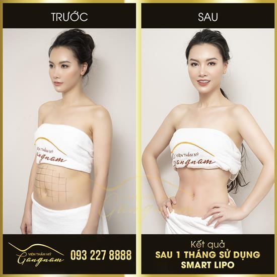 Giảm béo Smart Lipo: bước đột phá được công nhận bởi tổ chức uy tín thế giới - 6