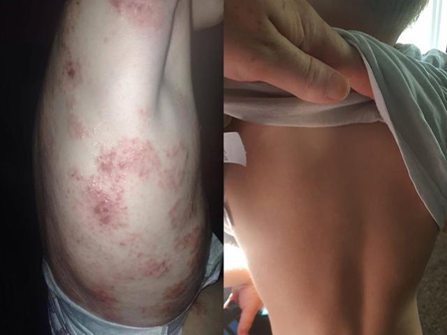 Sức khỏe đời sống - Bé trai bị chàm nặng trông như bị bỏng, nay khỏi bệnh nhờ thứ rẻ như cho này