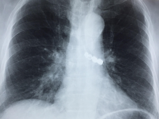 Cụ ông 90 tuổi bị rơi 4 chiếc răng giả vào phế quản - 1