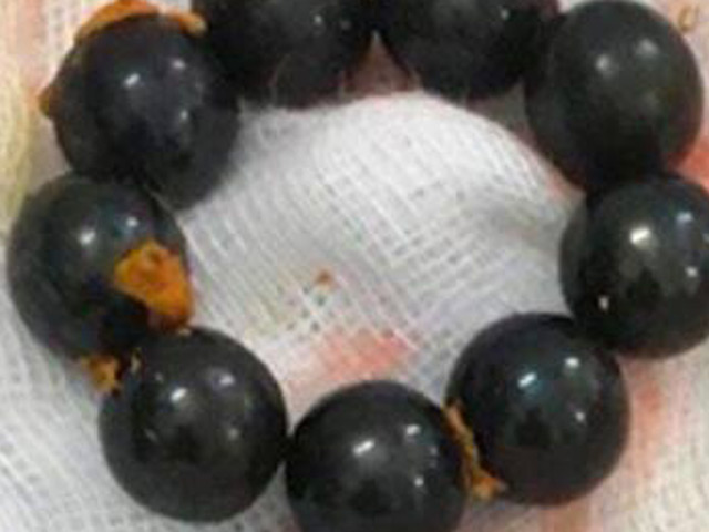 Bác sĩ bàng hoàng lấy 9 viên bi sắt trong bụng bé trai 10 tuổi - 1