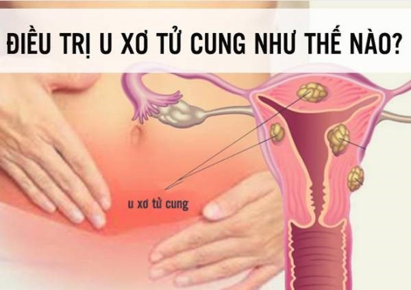 Hỗ trợ điều trị u xơ tử cung hiệu quả bằng sản phẩm thảo dược - 1