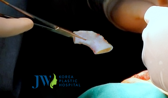 Sau nâng mũi cấu trúc có thể vặn lắc - 2