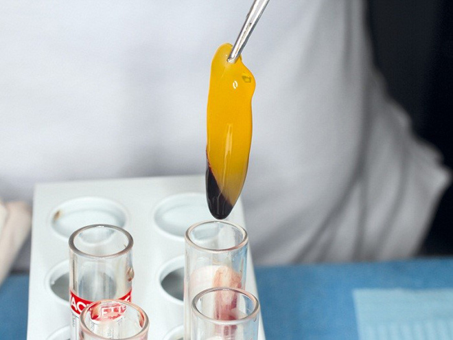 Sau nâng mũi cấu trúc có thể vặn lắc - 3