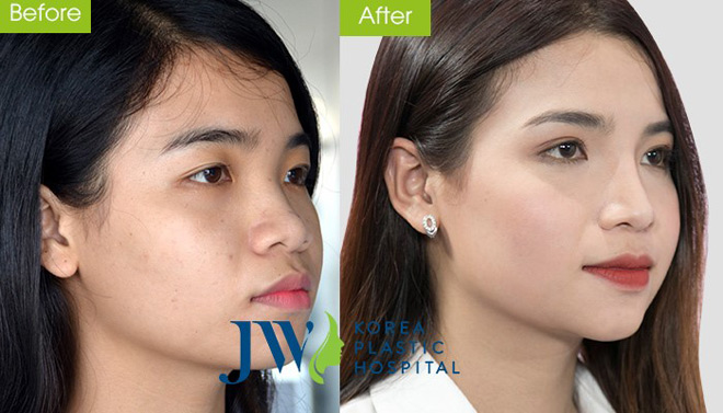 Sau nâng mũi cấu trúc có thể vặn lắc - 4