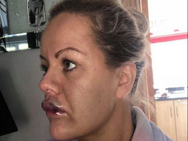 Làm đẹp - Suýt mù mắt, hỏng môi vì tiêm filler làm đầy khuôn mặt