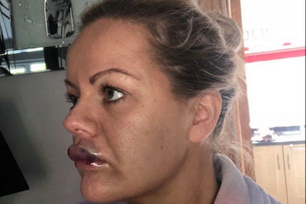 Nguy cơ mù mắt, hỏng môi vì tiêm filler làm đầy khuôn mặt - 2