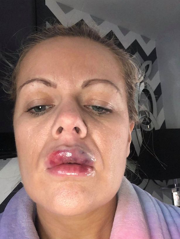 Nguy cơ mù mắt, hỏng môi vì tiêm filler làm đầy khuôn mặt - 3