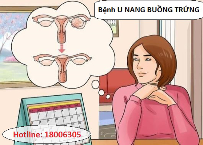 Bệnh u nang buồng trứng và những ảnh hưởng mà phụ nữ phải đối mặt - 1