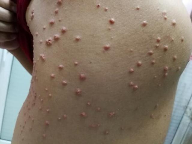 Sức khỏe đời sống - Mải mê với cốc bia giải nhiệt, ông bố trẻ tá hỏa vì người mọc nhiều u lạ