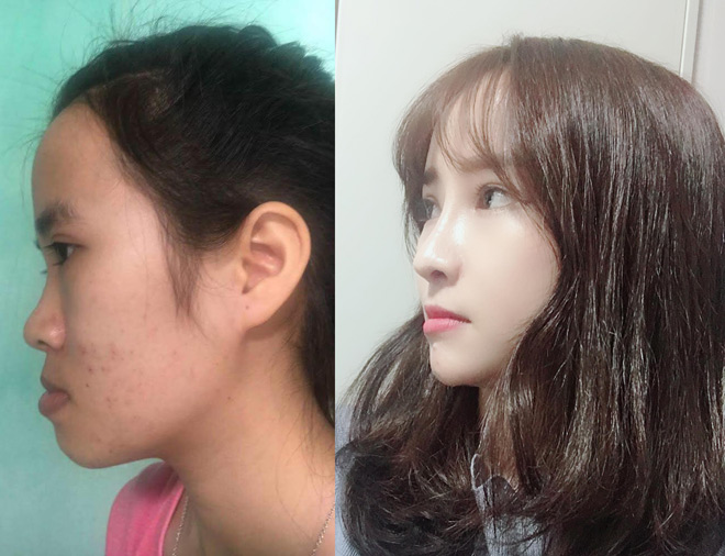 Sự thay đổi khó tin của cô gái từng bị bạn chế nhạo chỉ nên yêu người răng hô - 3