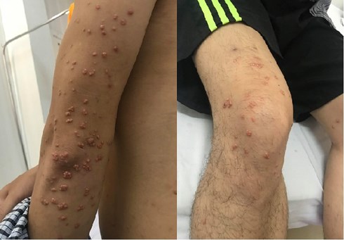 Mải mê với cốc bia giải nhiệt, ông bố trẻ tá hỏa vì người mọc nhiều u lạ - 2