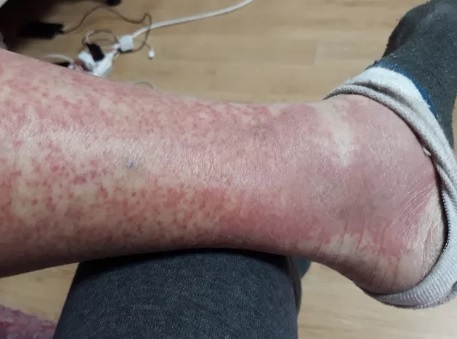 Nhầm với đau khớp, nhiều người phải cắt cụt chi vì căn bệnh hiểm - 1