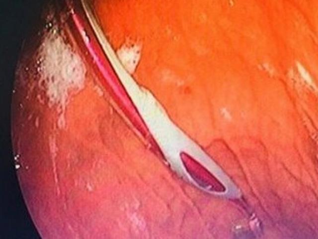 Media - Kinh hoàng bàn chải mắc kẹt trong dạ dày người đàn ông suốt 9 tháng