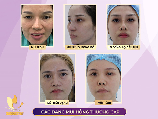 Bác sĩ nổi tiếng Sài Gòn chuyên “giải cứu” những ca thẩm mỹ mũi hỏng - 2