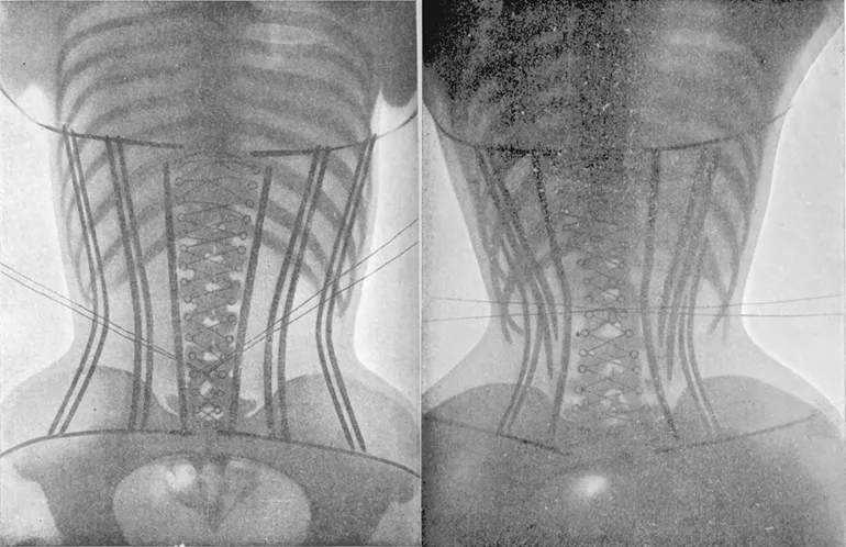 Ảnh chụp X quang tác động của áo nịt ngực đến xương của phụ nữ&nbsp;