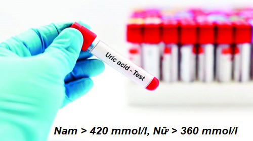 Chỉ số acid uric cao làm hình thành tinh thể urat