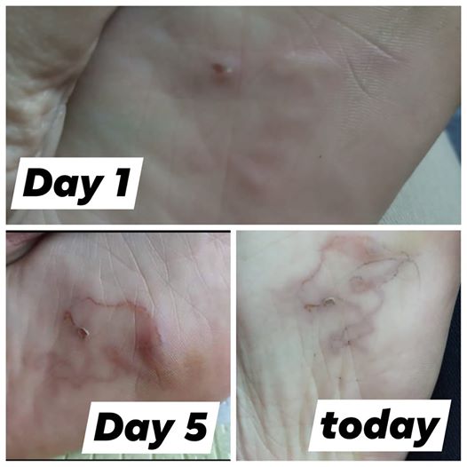 Kinh hoàng phát hiện giun bò loằng ngoằng dưới lòng bàn chân sau khi đi biển về - 2