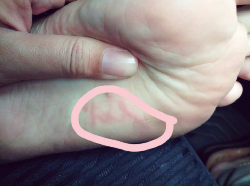 Kinh hoàng phát hiện giun bò loằng ngoằng dưới lòng bàn chân sau khi đi biển về - 1