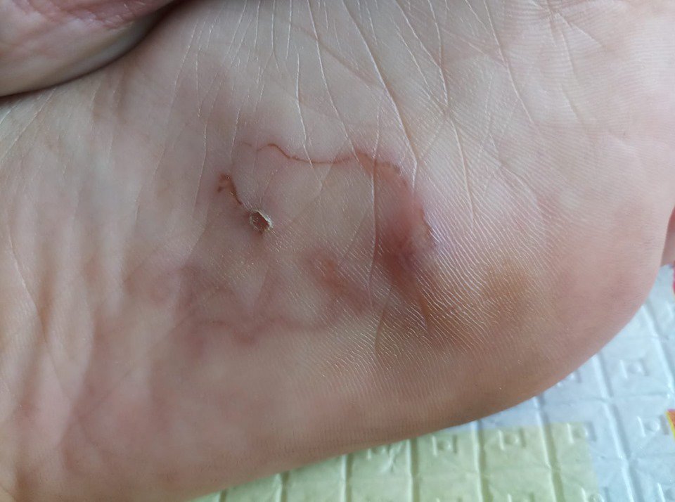 Kinh hoàng phát hiện giun bò loằng ngoằng dưới lòng bàn chân sau khi đi biển về - 3