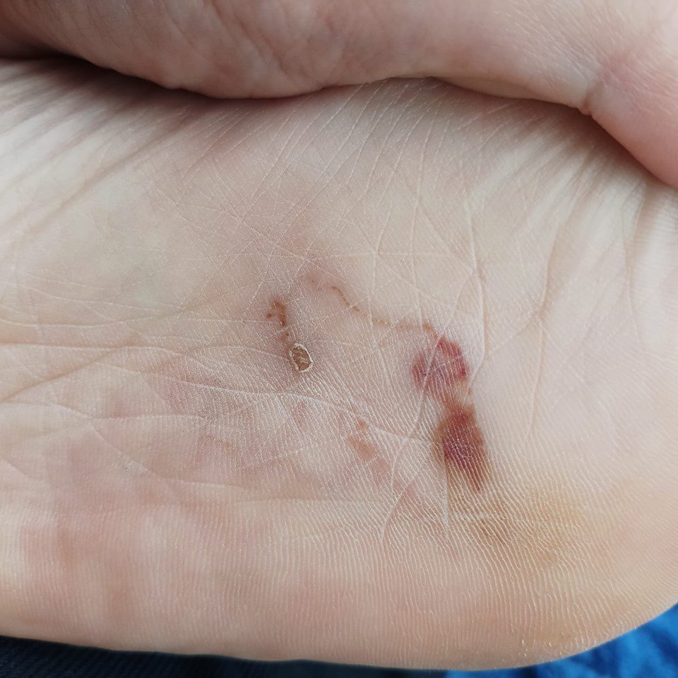 Kinh hoàng phát hiện giun bò loằng ngoằng dưới lòng bàn chân sau khi đi biển về - 4