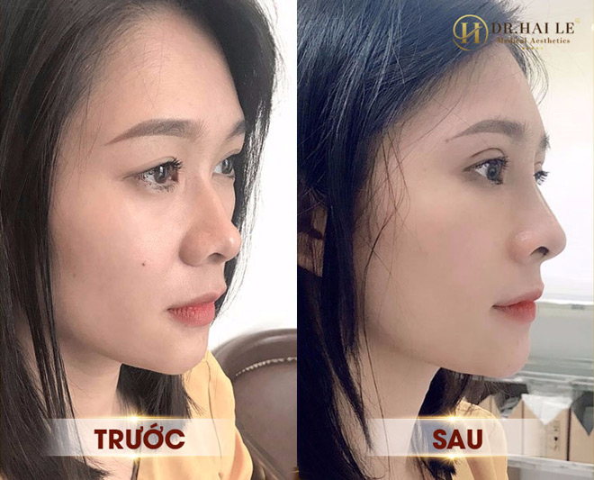 Khách hàng sử dụng combo nâng mũi và cắt mí tại Dr.Hải Lê