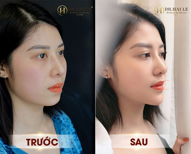 Cô nàng Vân Anh “biến hóa” sau ca độn cằm V-Line tại Dr.Hải Lê