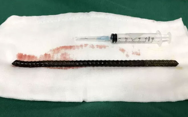 Dị vật sau khi được lấy ra