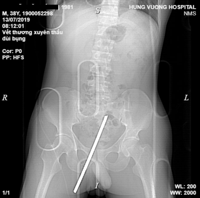 Hình ảnh phim chụp cho thấy thanh sắt suýt xuyên thấu "của quý" nạn nhân