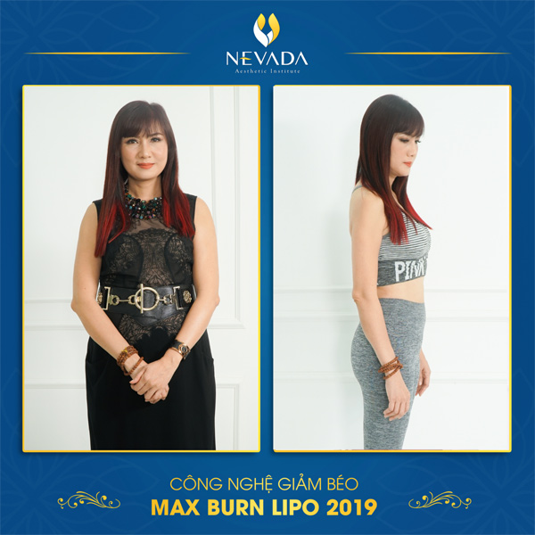 Nghệ sĩ Hiền Mai giảm mỡ bụng bằng công nghệ Max Burn Lipo