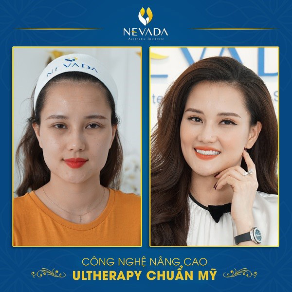 MC Huyền Châu khắc phục tình trạng da chảy sệ bằng công nghệ Ultherapy