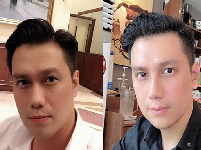 Làm đẹp - Tiêm hàm như Việt Anh "Người phán xử" thế nào để mặt không bị đơ?