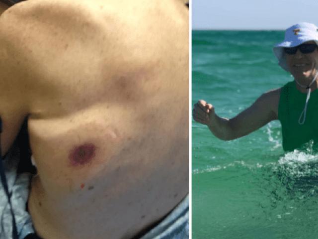 Phi thường - kỳ quặc - Ra biển tắm, người đàn ông trở về với vết bầm, hai ngày sau tử vong đau đớn