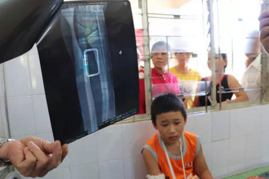 Kết quả chụp phim cho thấy cánh tay của Linh bị gãy phải bó bột