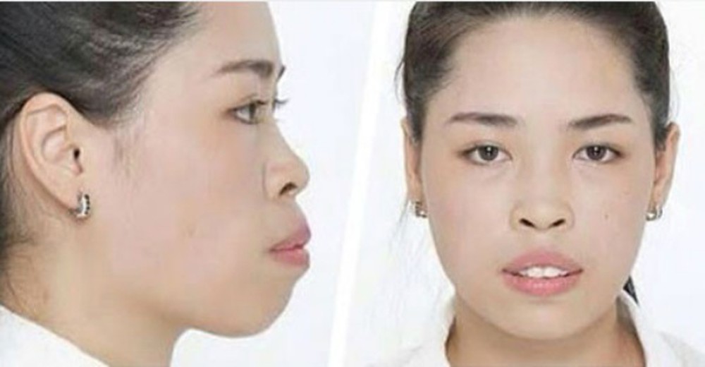 Vũ Thanh Quỳnh trước khi phẫu thuật thẩm mỹ