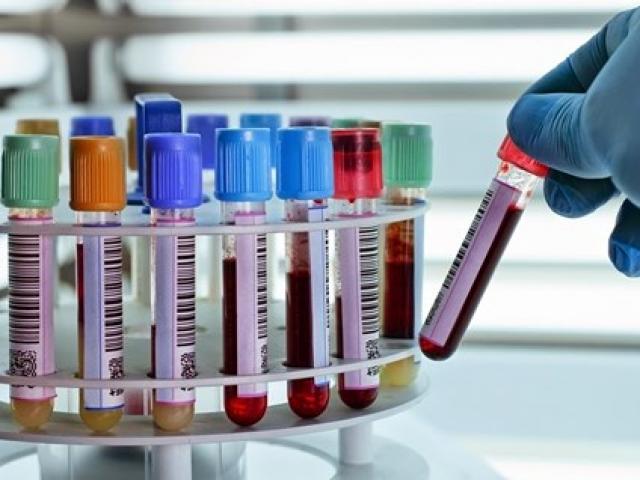 Sức khỏe đời sống - Xét nghiệm gen sàng lọc ung thư: Phó chủ tịch Hội ung thư Việt Nam nói gì?