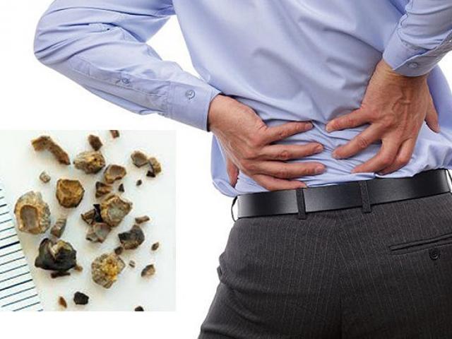 Sức khỏe đời sống - Hỏng cả đời vì coi thường 'mấy viên sỏi nhỏ' ở thận