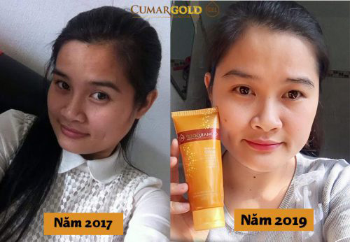  Làn da thay đổi rõ rệt kể từ ngày chị dùng CumarGold Gel