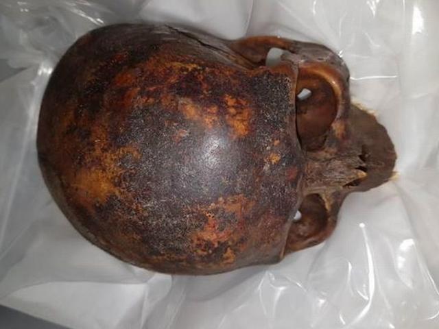 Thế giới - Ireland: Tỉnh dậy sau cơn say, thấy 2 hộp sọ trong túi và sự thật bất ngờ