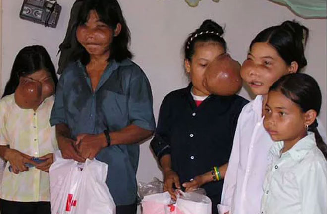 Năm người con của ông Lục Văn Quân trước khi phẫu thuật