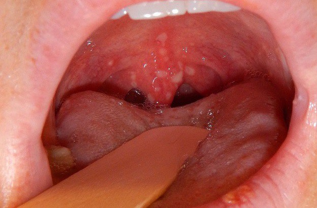 Ung thư vòm họng có liên quan đến virus EBV