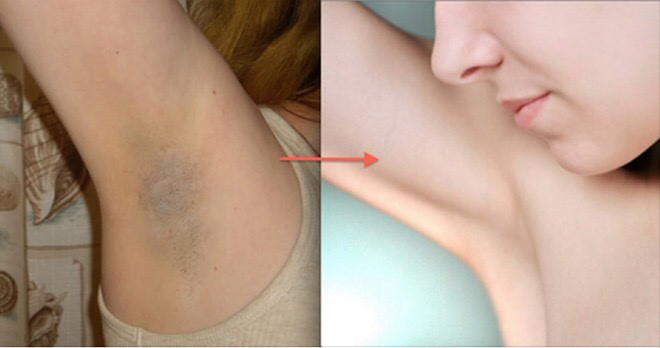 Sau khi dùng Serum nách Robert Williams tôi đã khác, tự tin hơn, áo 2 dây cỡ nào cũng không ngại