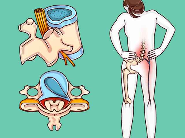 Sức khỏe đời sống - Bác sĩ tiết lộ cách chữa bệnh đau cột sống cực hiệu quả không cần dùng thuốc