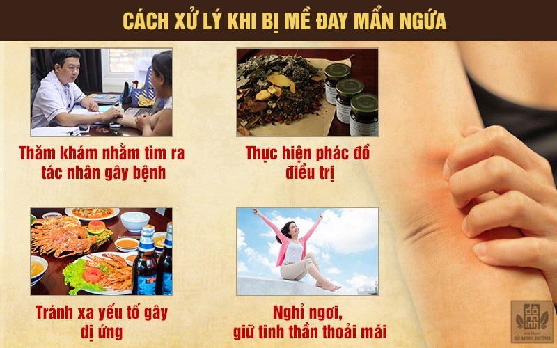 Dị ứng nổi mề đay mẩn ngứa mãn tính: Triệu chứng và cách điều trị không tái phát - 2